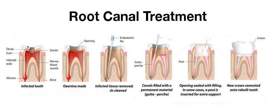 Root canal treatment