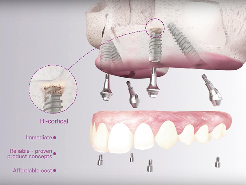 denture diagram